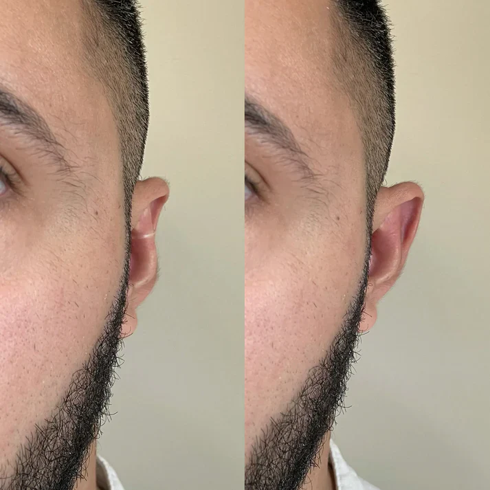 Exemplo de antes e depois do OttoFlex