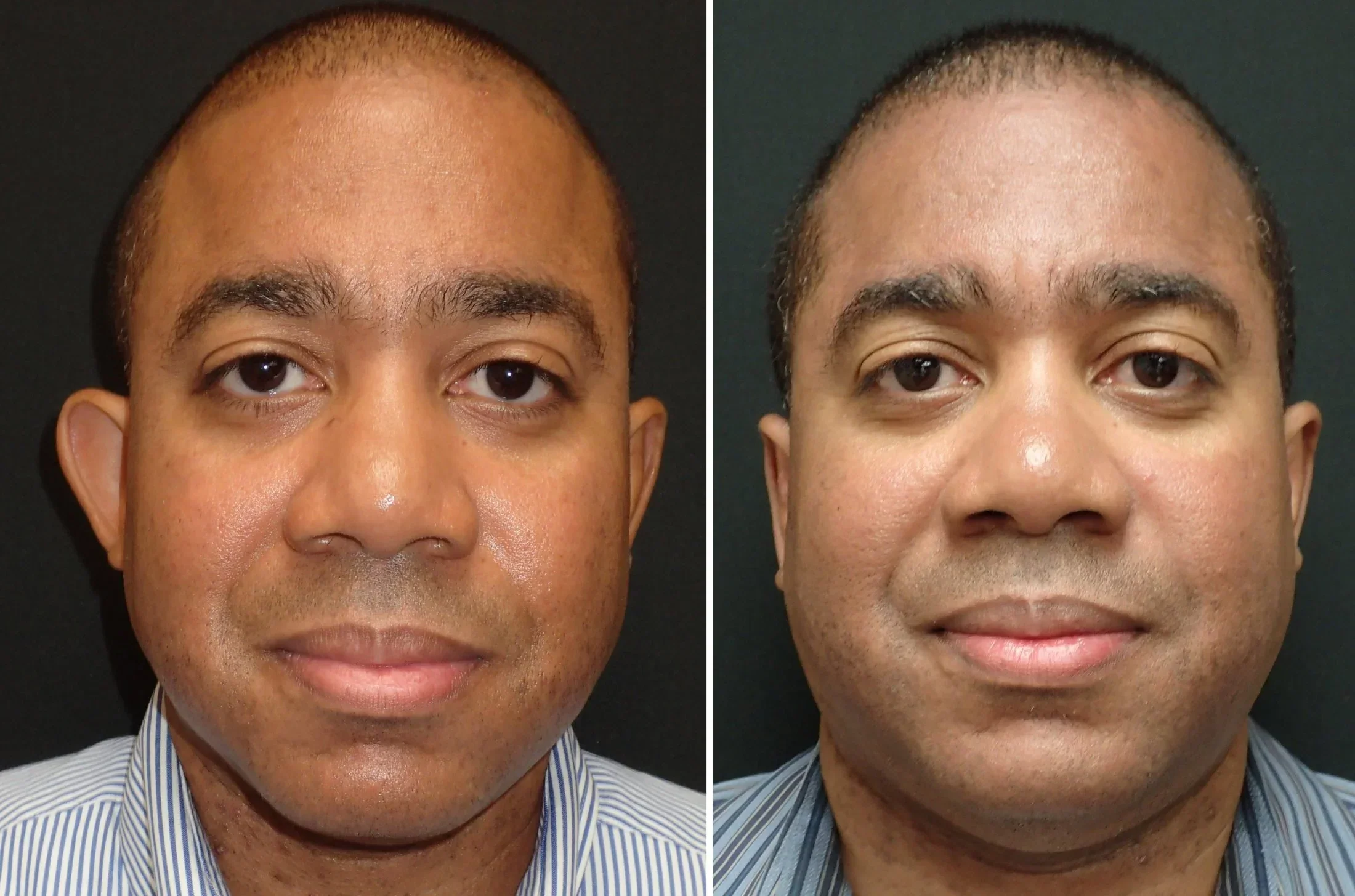 Outro exemplo de antes e depois